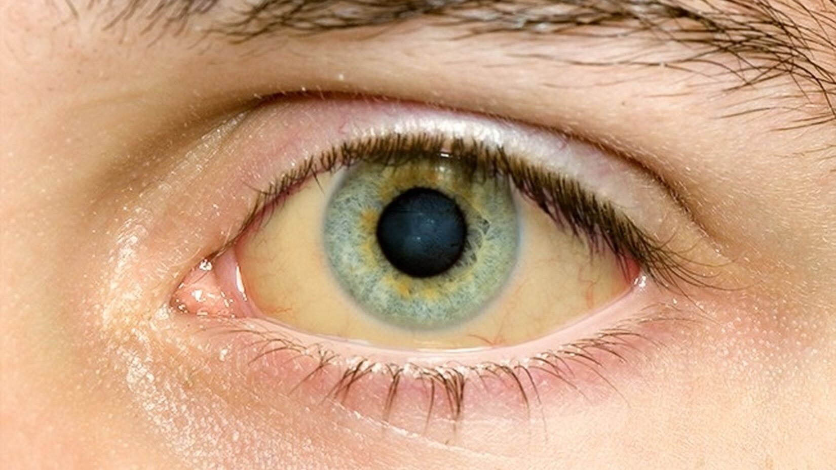 Желтое лицо и желтые белки глаз: причины, диагностика, лечение