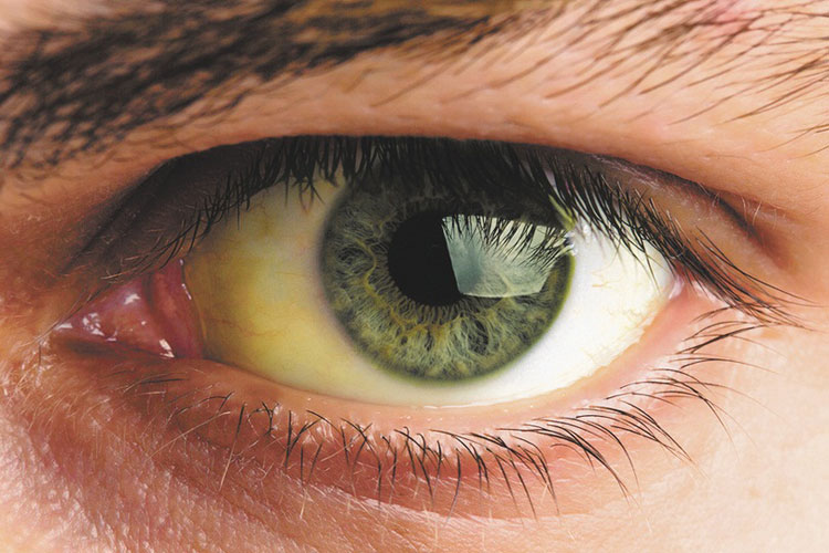 Почему желтеют белки глаз?