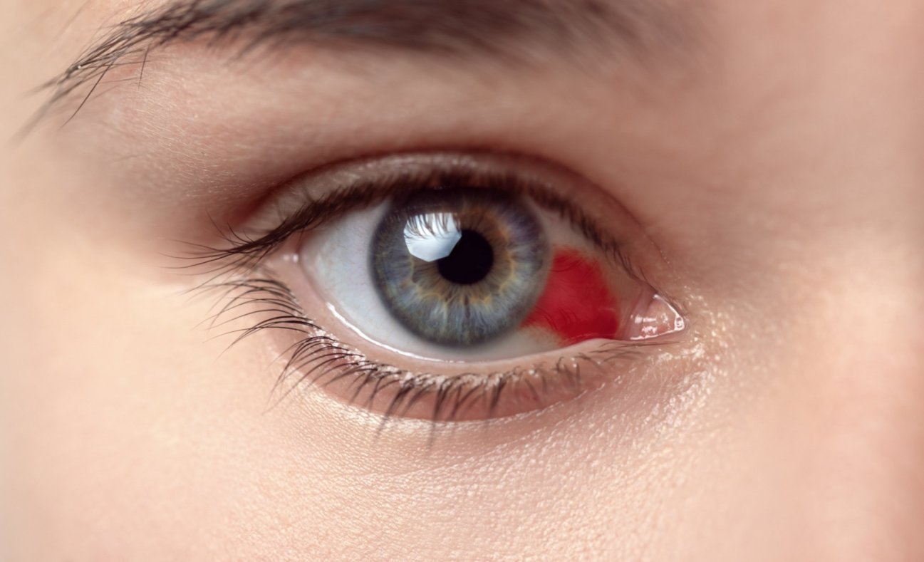 Кровоизлияние в стекловидное тело глаза: как лечить гемофтальм?